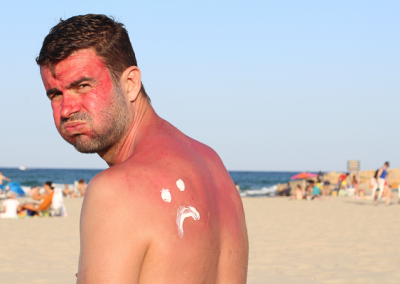 Sunburn